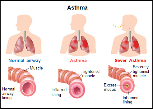 Asthma airways